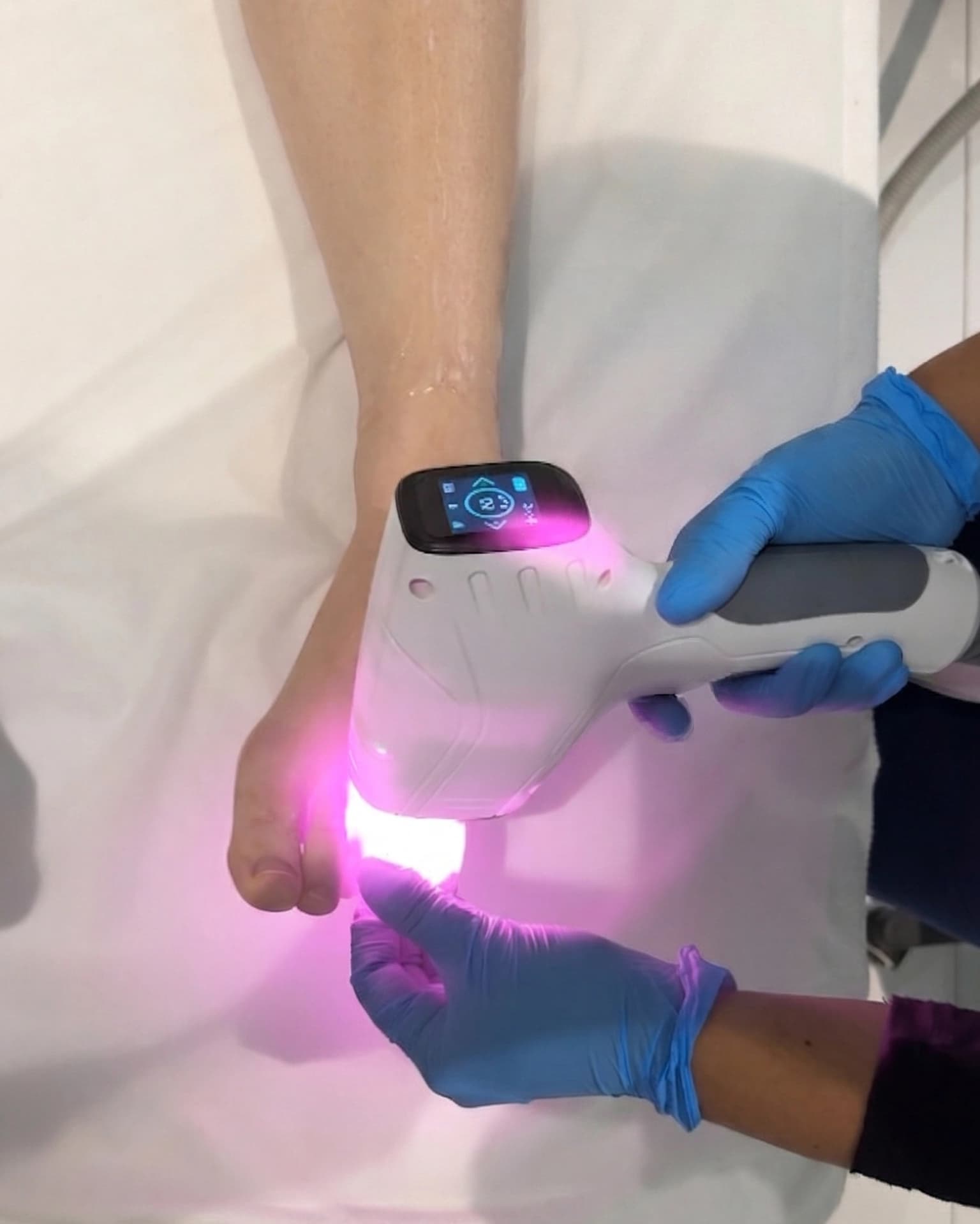 Laser Hair Removal